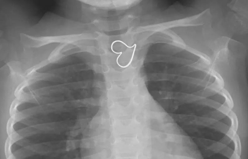 Aparece una forma de corazón en la radiografía de una niña |