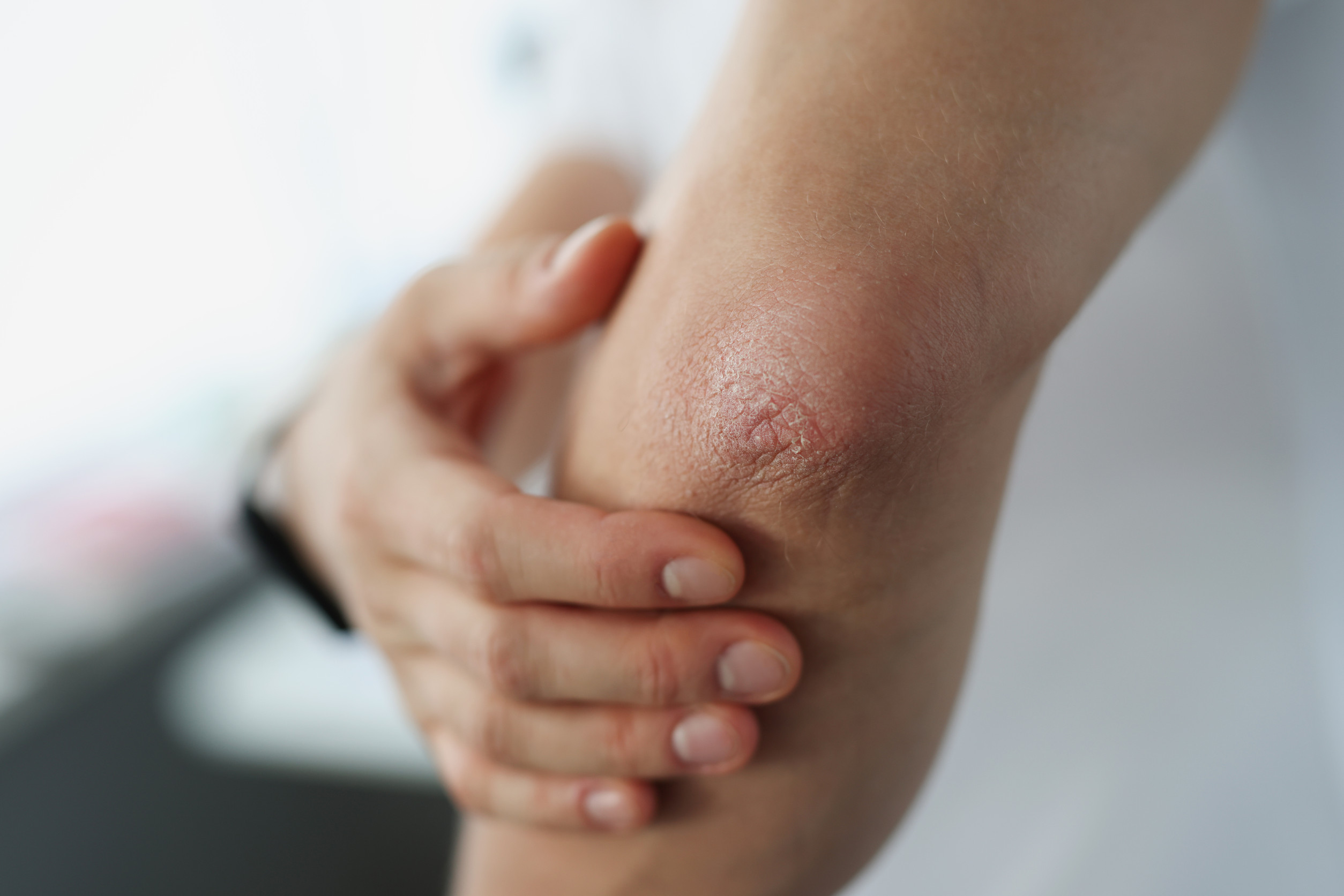 psoriasis